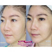 สบู่ Royal Beauty White Anti-Melasma Soap 60g. (1กล่องมี 4 ก้อน)ร้านค้าเครื่องสำอางค์ ขายเครื่องสำอาง สกินแคร์ ครีมกันแดด และเคาท์เตอร์แบรนด์ กว่า 2000 รายการ ของแท้ 100% เว็บเครื่องสำอาง ไอเท็มความงาม